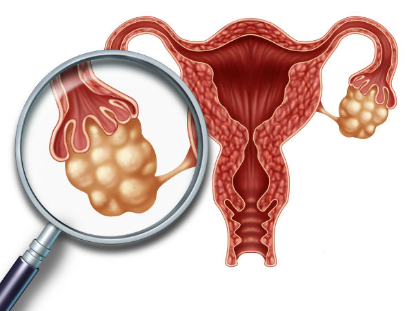 Поликистоза на яйчниците